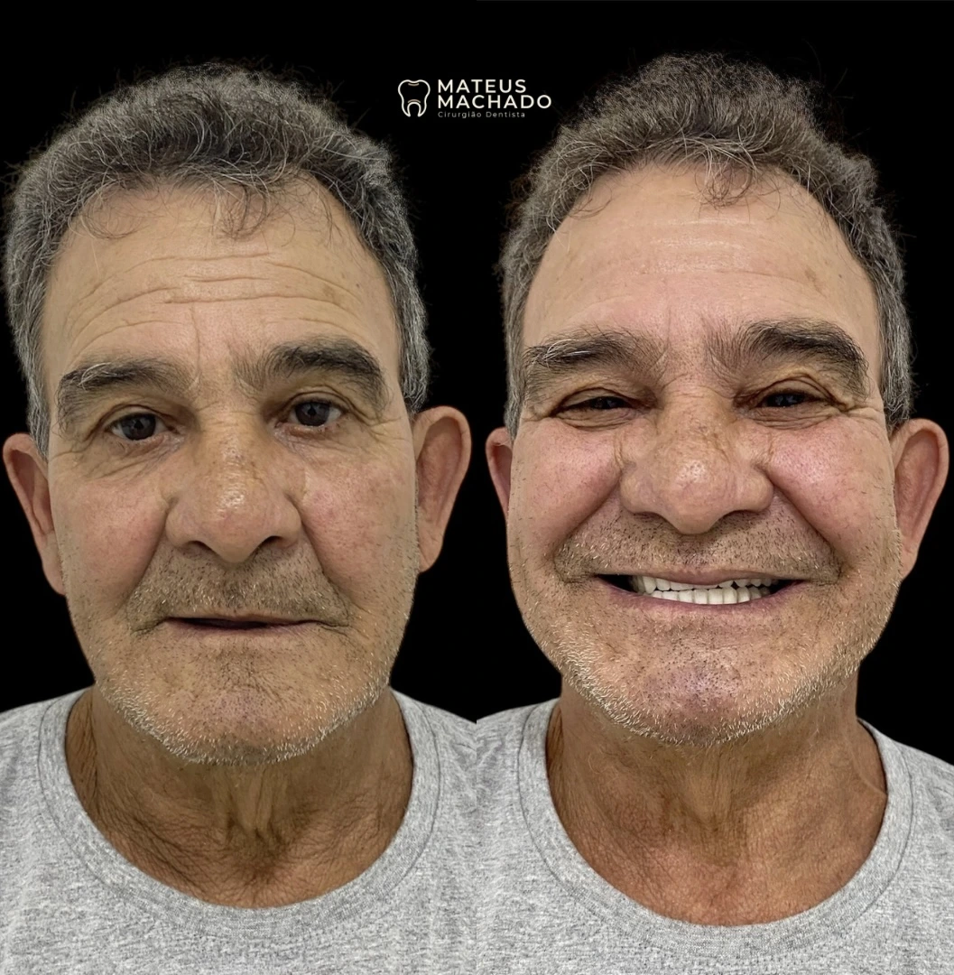 Caso clínico realizado pelo Dr. Mateus Machado