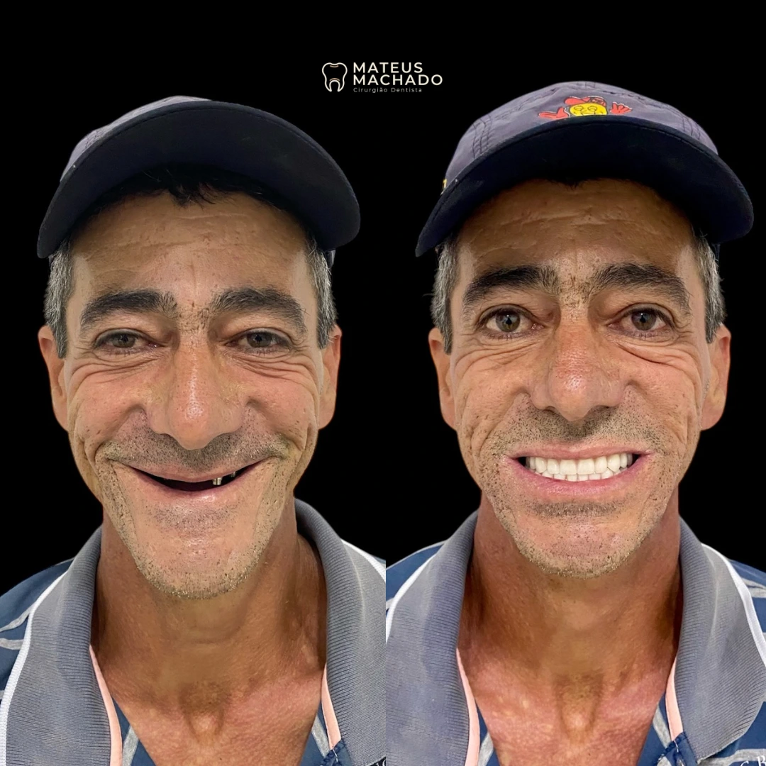 Caso clínico realizado pelo Dr. Mateus Machado