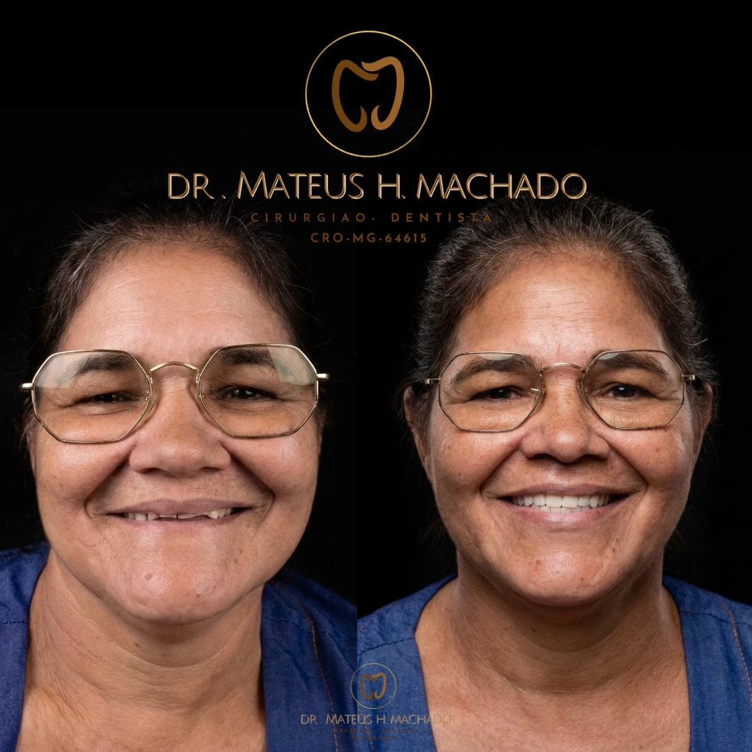 Caso clínico realizado pelo Dr. Mateus Machado