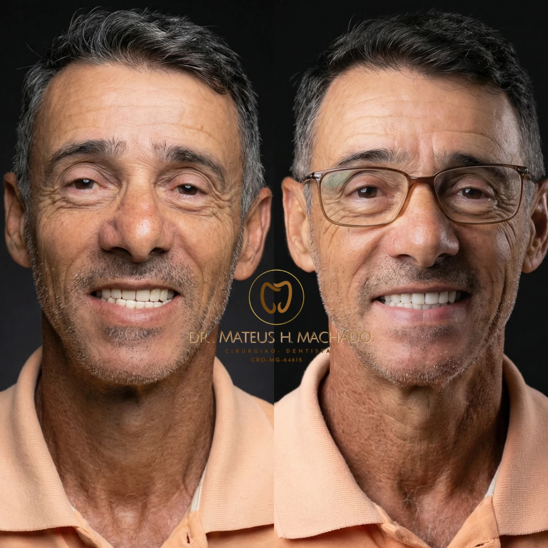Tratamento com prótese dentária comum