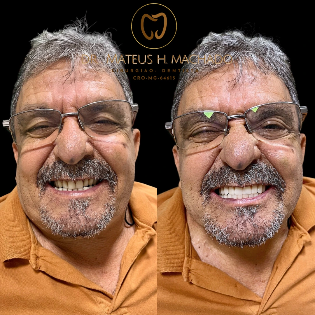 Caso clínico realizado pelo Dr. Mateus Machado