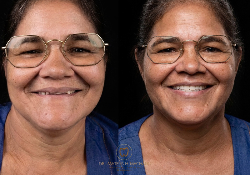 Tratamento com implantes dentários
